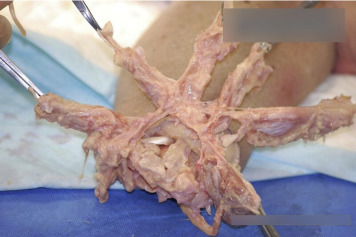 PIcture of metacrapal muscles mid-dissection resembling a similar shape to a starfish