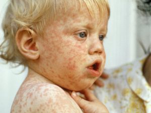 Baby with Measles